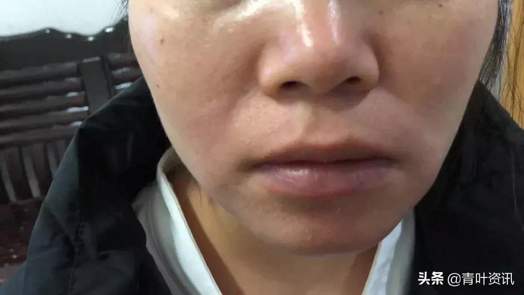 吃火锅过敏起红疹子,夏天吃火锅过敏