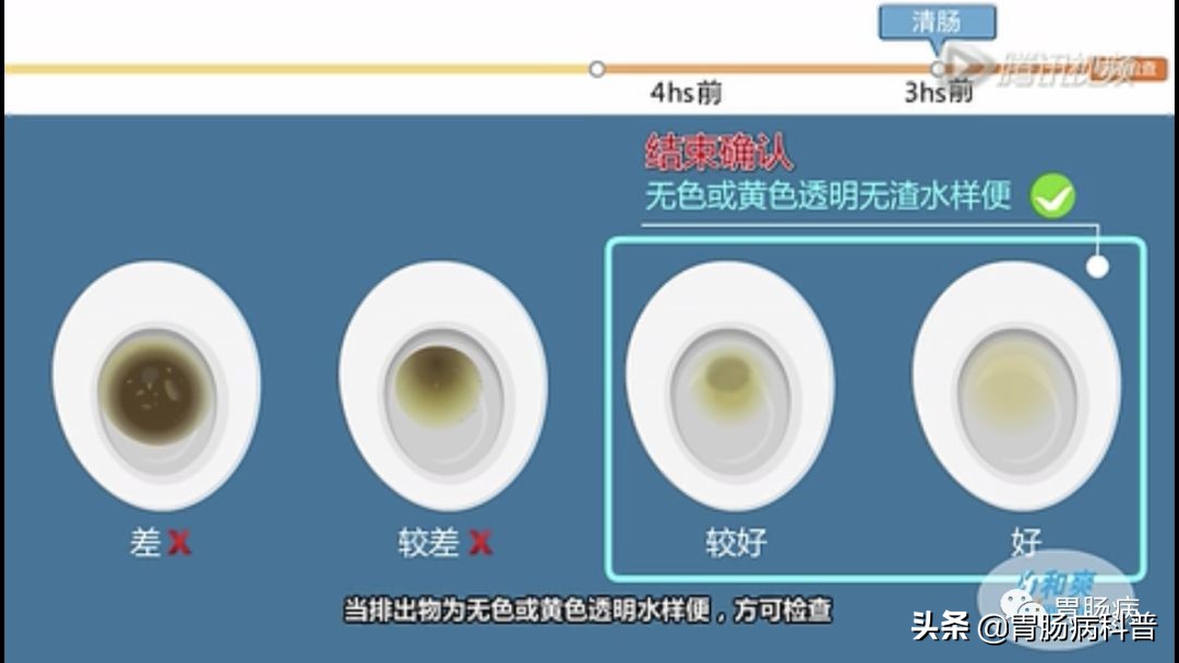 做肠镜是怎么清肠的,做肠镜如何能清肠