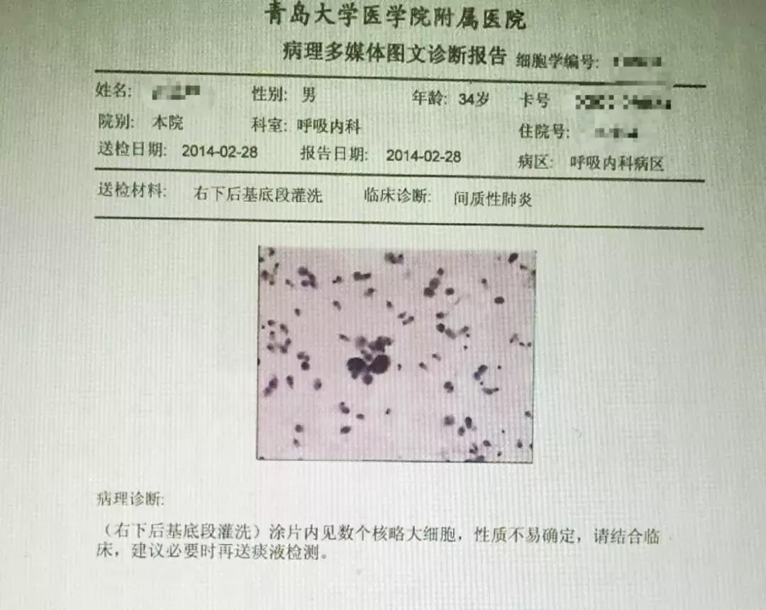 肺纤维化病例,肺纤维化手指甲发紫还能活多久