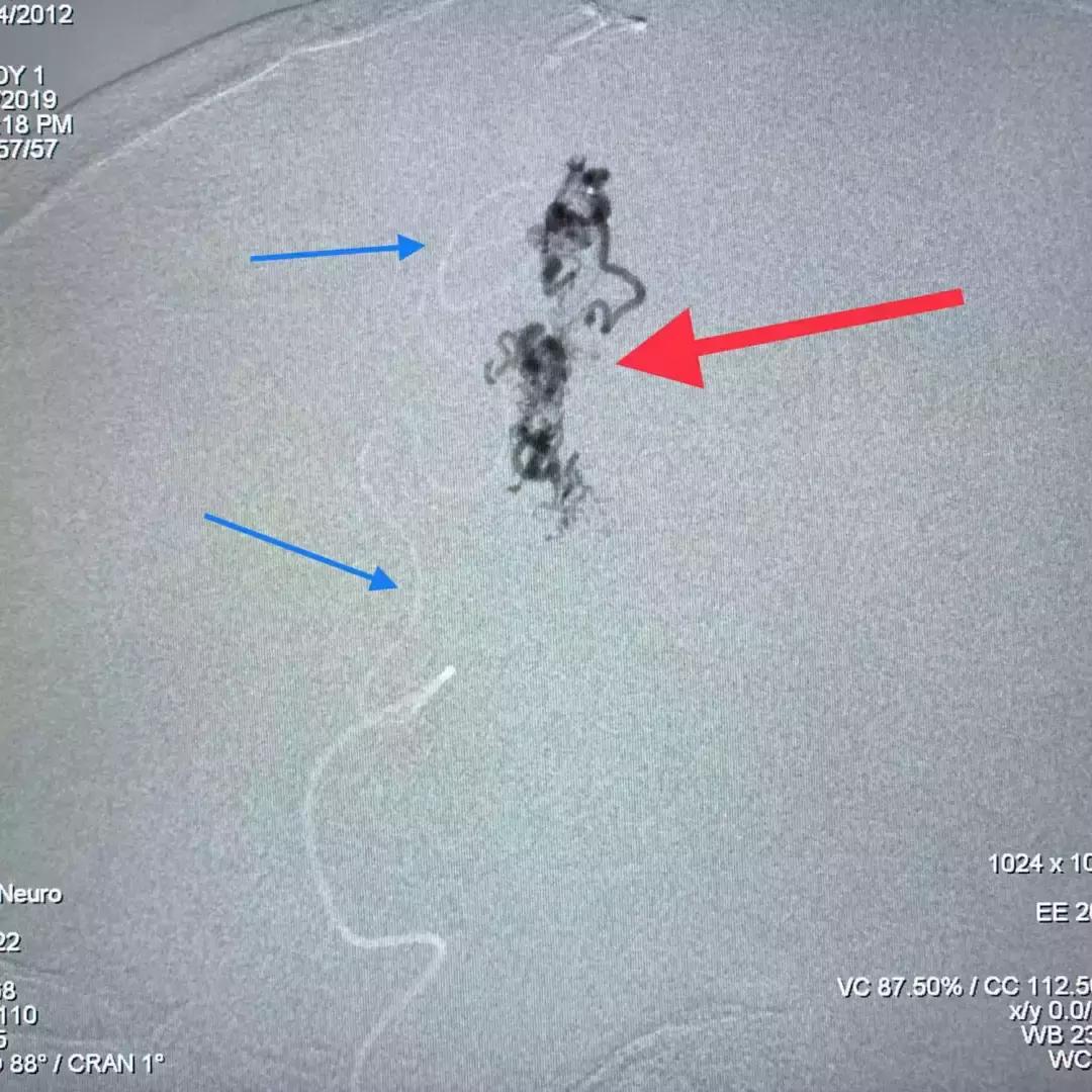 北京三博脑科医院康复治疗,北京三博脑科医院治脑血管瘤怎样