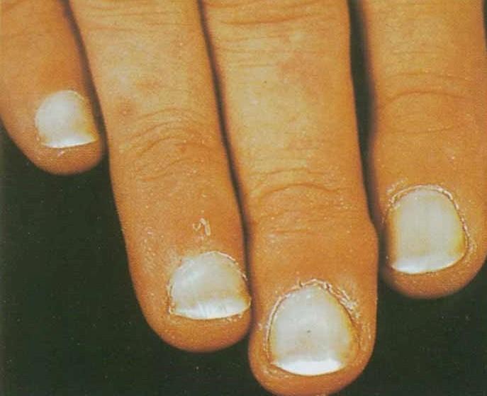 小小的指甲隐藏大大的健康秘密,小小指甲大调查