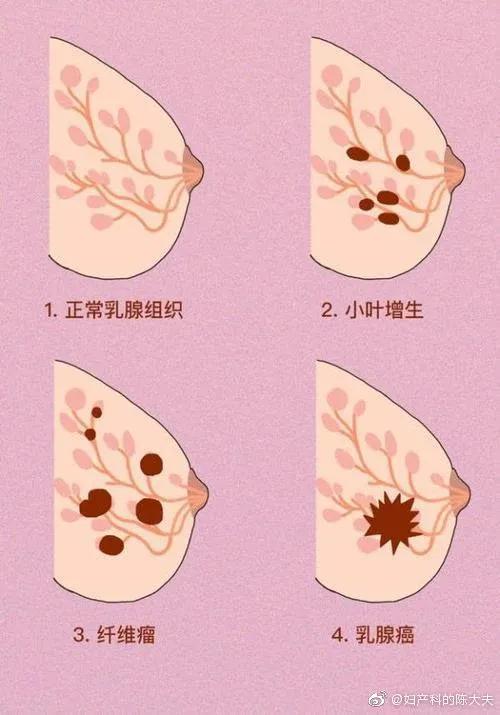 乳腺增生会导致胸部大小不一吗,乳腺增生严重还是乳房结节严重