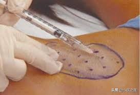 如何治狐臭腋下出汗,腋下轻微出汗有腋臭怎么治