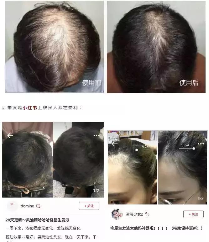 发际线高头发稀疏掉头发怎么拯救,发际线后移的头发还能长出来么