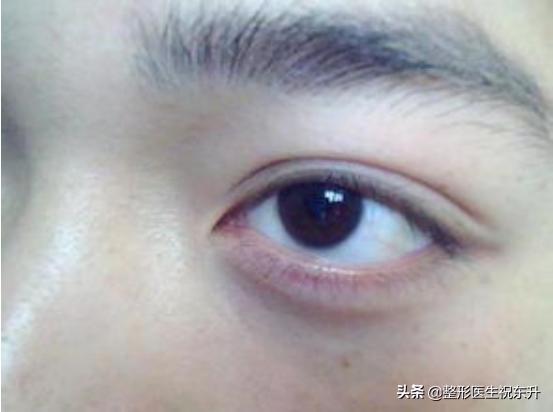 眼袋外切14天睑外翻多久可以恢复,外切眼袋如何避免下睑外翻