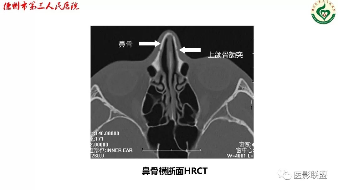 鼻骨骨折dr影像表现,鼻骨骨折影像学诊断