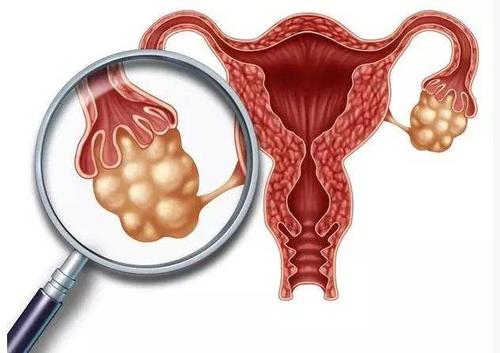 多囊卵巢综合征导致不孕能治好吗,协和医院内分泌科多囊卵巢