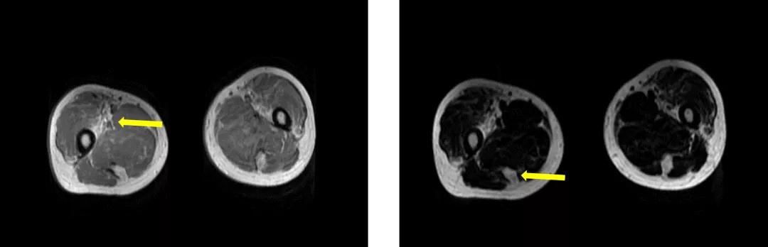 消化道出血高钾血症治疗,诊断高碳酸血症的金标准是什么
