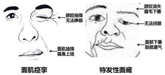 面肌痉挛手术后多久能恢复正常,全国第一名治疗面肌痉挛的医院