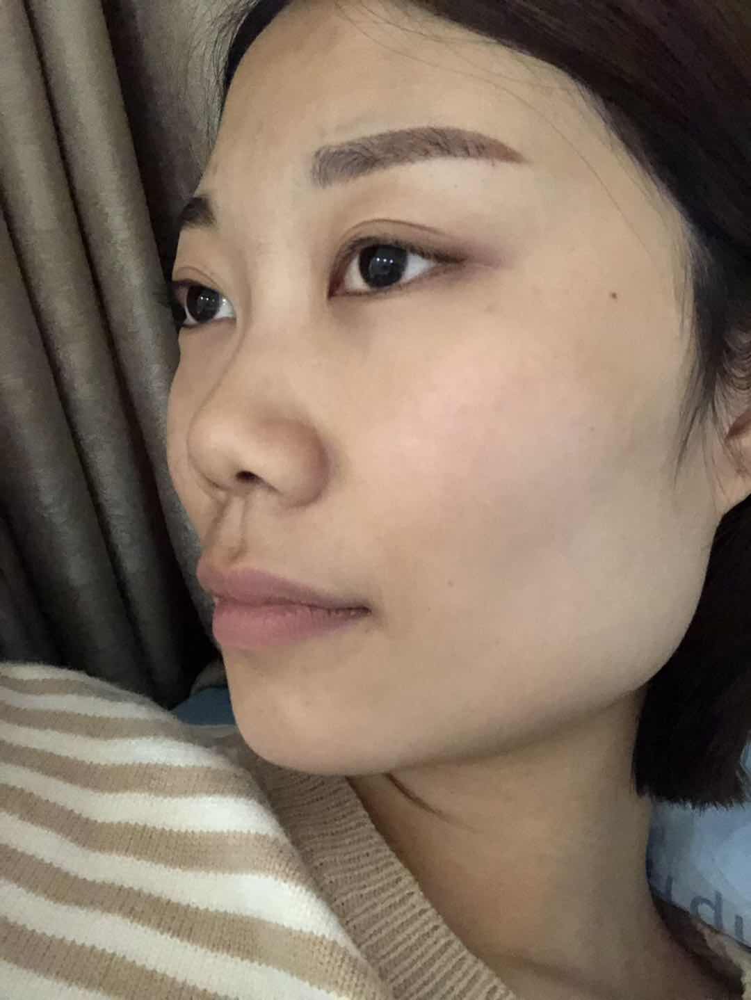 5万整容手术成功案例,女子花50万整容变毁容