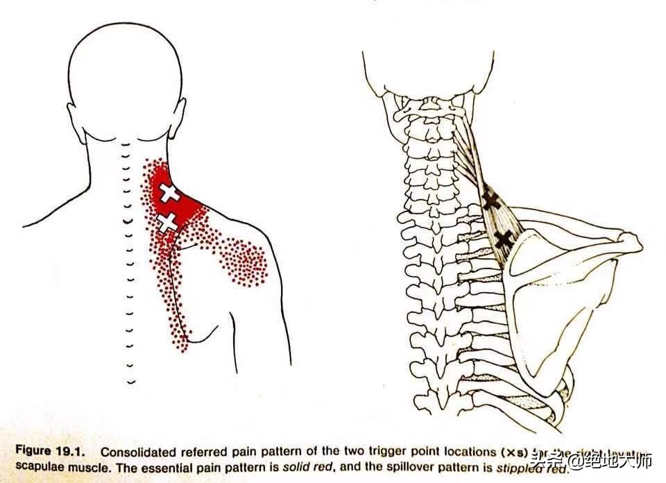 肩胛神经疼痛,肩胛提肌神经疼痛怎么治