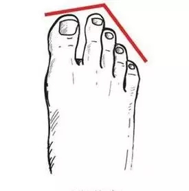 你的脚是正常脚型吗,你的脚型属于哪种呢