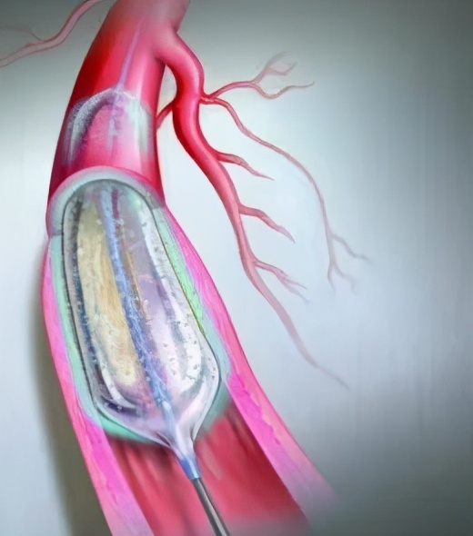 心梗导致心衰可以不做支架,心梗可以不做支架只疏通吗