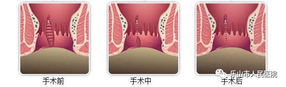周期性疼痛肛裂,女便血肛裂便秘怎么用药