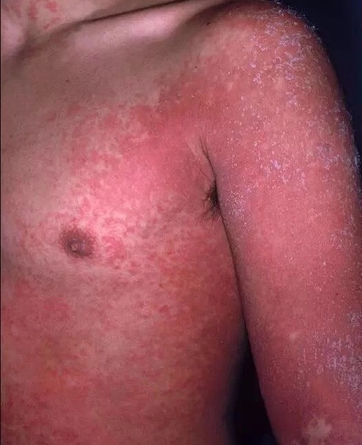 如何判断婴儿湿疹还是脂溢性皮炎,宝宝脂溢性皮炎是干性湿疹吗