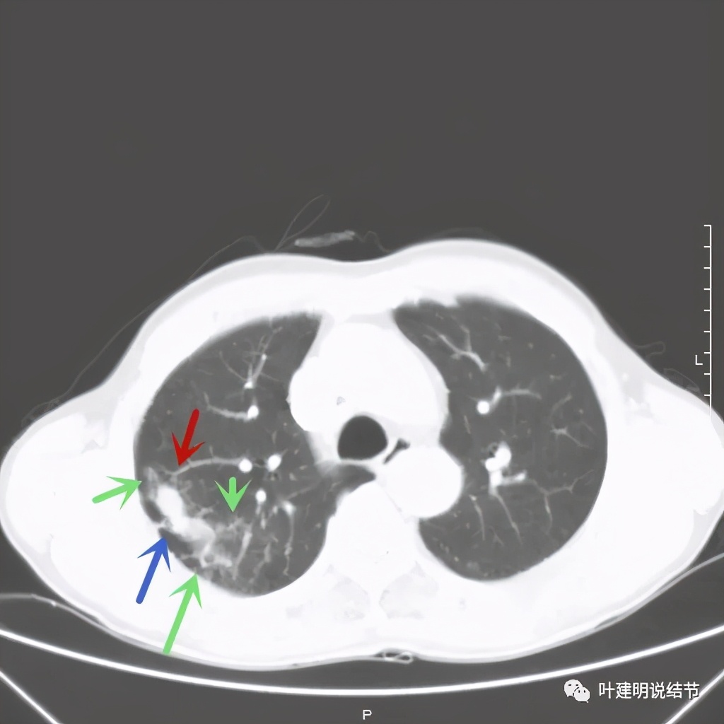 肺占位病理活检无病变,肺部占位穿刺病理说不确定性质