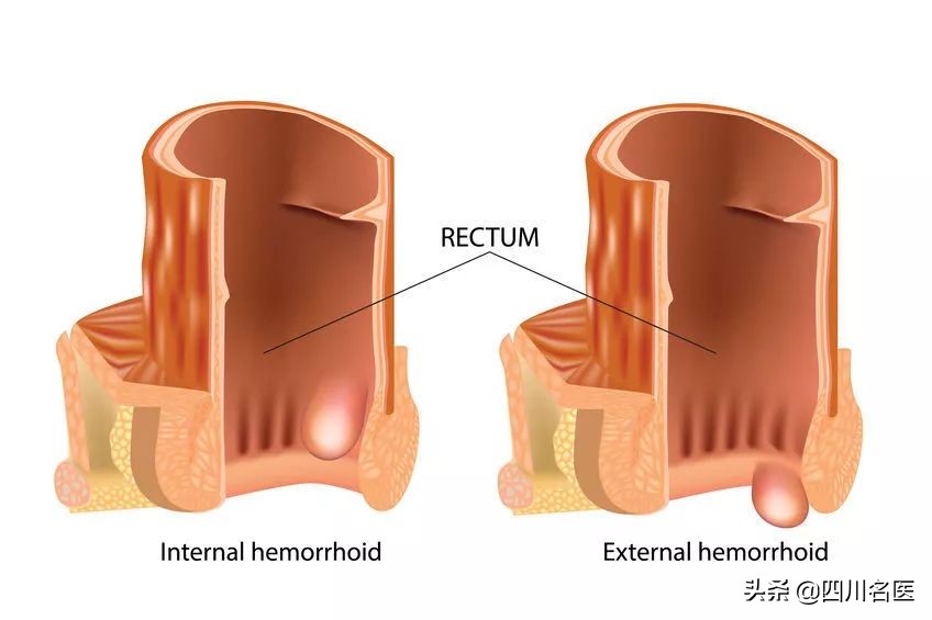 为什么会得痔疮听听医生怎么说,为什么医生很少得痔疮呢