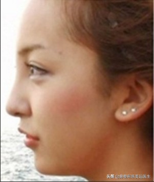 山根混血,混血鼻子山根一般多高