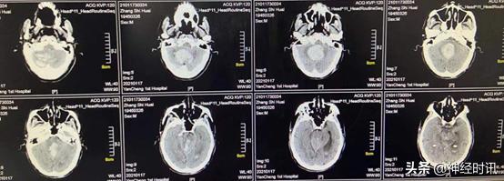 高血压小脑出血治愈率多大,高血压导致小脑出血