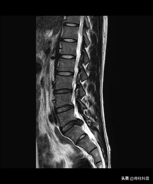 腰椎间盘突出怎样保养才不会复发,腰椎间盘突出症微创术后会复发吗