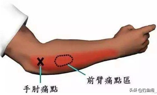 钓鱼香虎手能彻底根除吗,香虎手治好后还能钓鱼吗