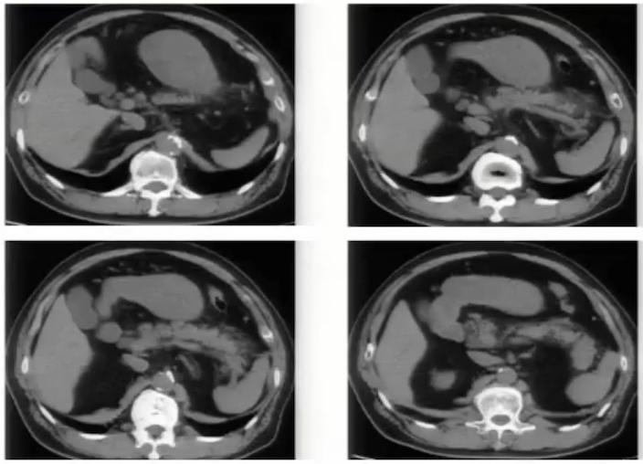腹部ct详细讲解,腹部ct示意图及超详细教学