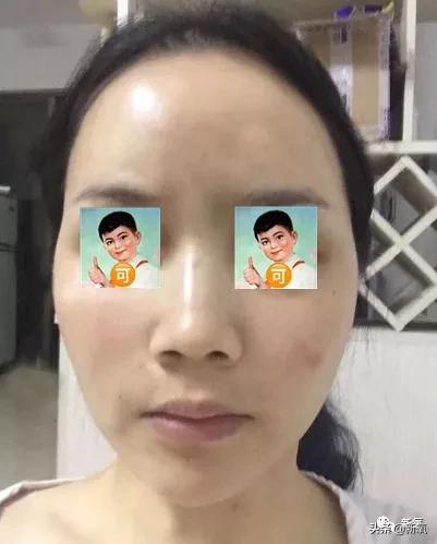 网红整鼻子整出坑,千万网红被坑