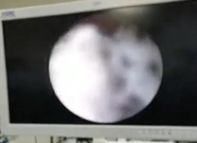 儿童萌芽性出血,两岁女孩出现出血