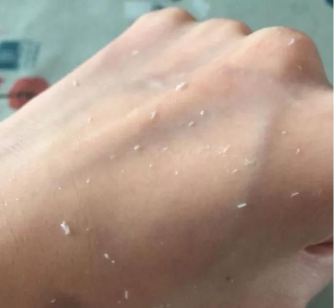 敏感干燥起皮泛红怎么修复,泛红起皮有刺痛感如何护肤