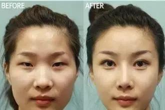 什么眼型需要开眼角,什么眼型适合化妆开眼角