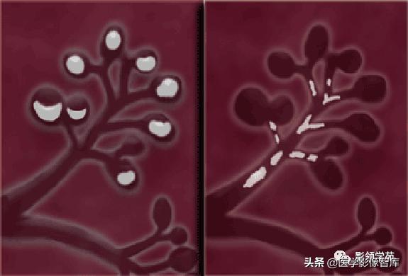 乳腺钙化怎么区分良性和恶性,乳腺钙化的诊断与分级