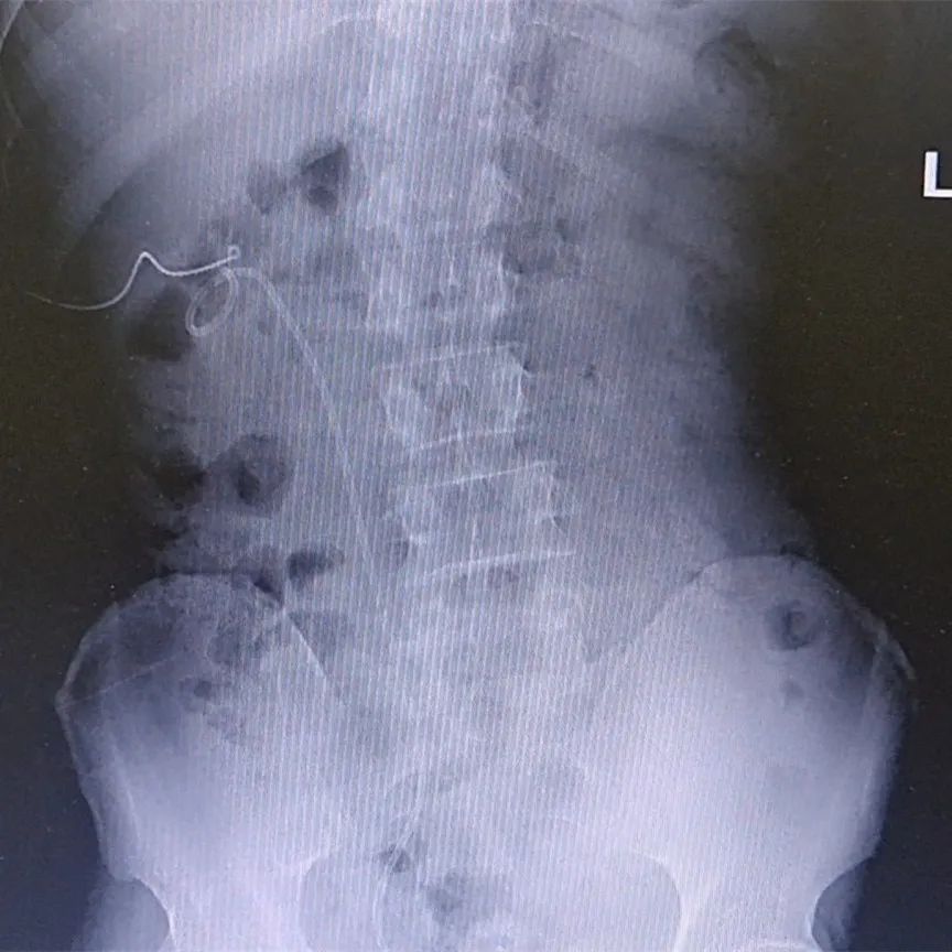 泌尿系结石的中西医最新治疗,泌尿系统结石的难点