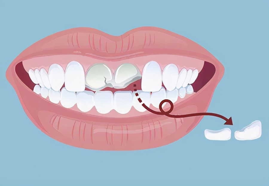 牙齿断裂会导致什么危害？该怎么解决？