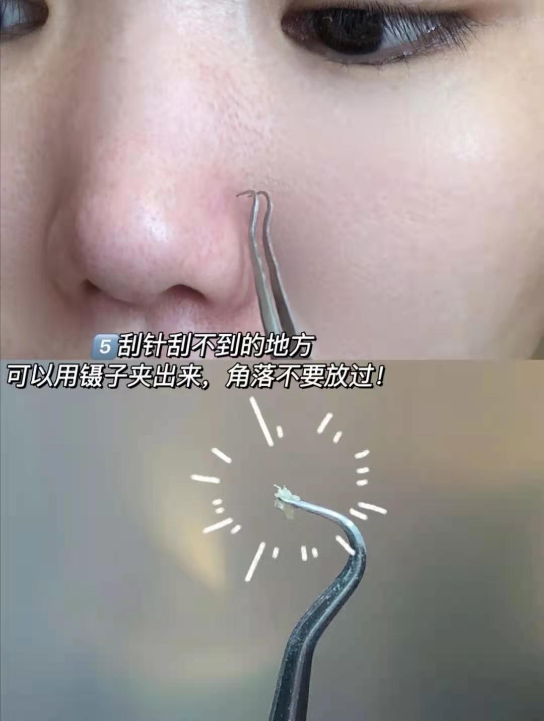 去黑头收缩毛孔的最好方法洗面奶,去黑头收缩毛孔的最好方法多少钱