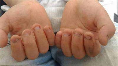 孩子总咬手有什么办法戒掉,7-12岁儿童咬手指怎么矫正