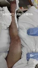 新冠引起静脉血栓怎么治疗,静脉血栓是新冠高危人群吗