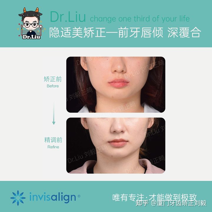 厦门透明牙齿矫正器矫正时间,厦门成人隐形牙齿矫正价格