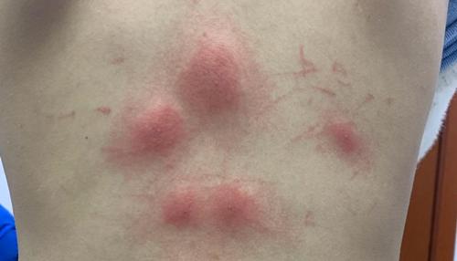 起了类似蚊子咬的疙瘩有点痒,蚊子咬的硬疙瘩奇痒无比