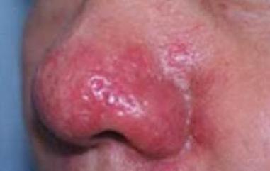 如何应对酒糟鼻,得了酒糟鼻怎么处理好得快