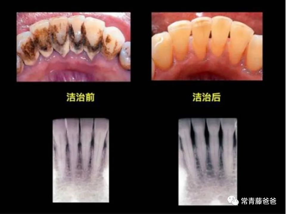 孩子有了龋齿刷牙还有用吗,用牙线清理牙缝很臭是蛀牙吗