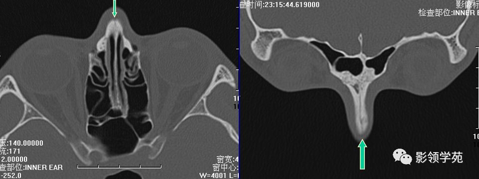 鼻骨影像学解剖,鼻骨解剖及骨折影像学诊断