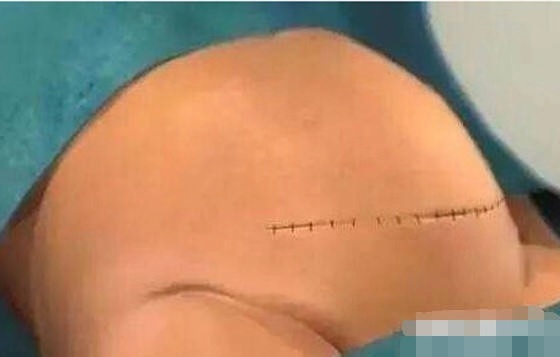 剖宫产真的比顺产好吗,剖宫产全过程解析