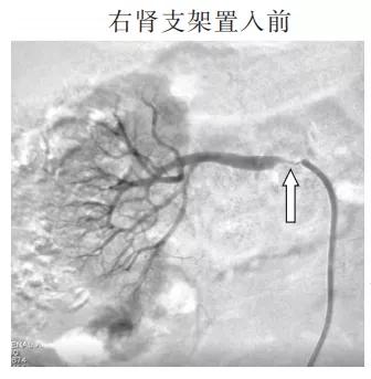 血肌酐118可以降到正常吗,肌酐136肾功能损伤严重吗
