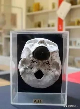 150年来从人体内取出的各式物品