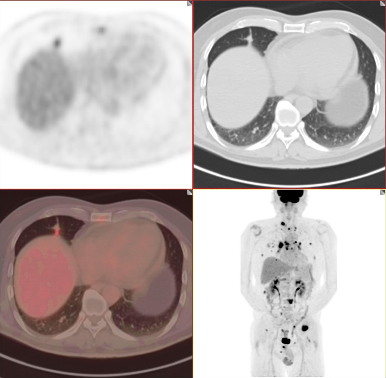 肺癌双肺弥漫转移生存期,肺结节小但是骨转移