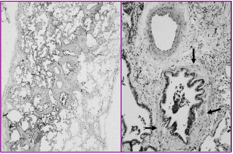 养鸽子造成皮肤真菌感染,养鸽子会得肺炎吗