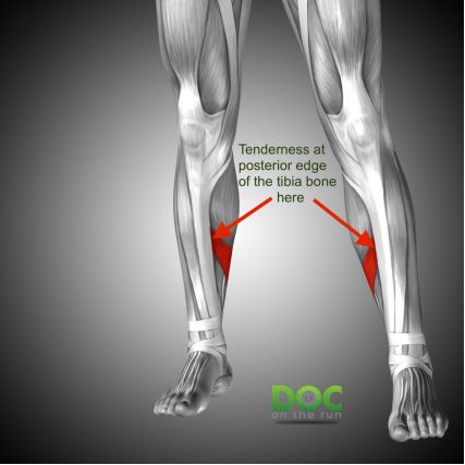 小白跑步容易伤哪个部位,初跑者小腿酸痛怎么办