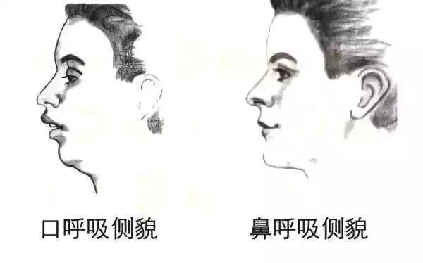 “龅牙”是深覆颌还是深覆盖,两者如何区分?