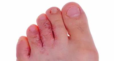 前脚掌疼痛,前足疼