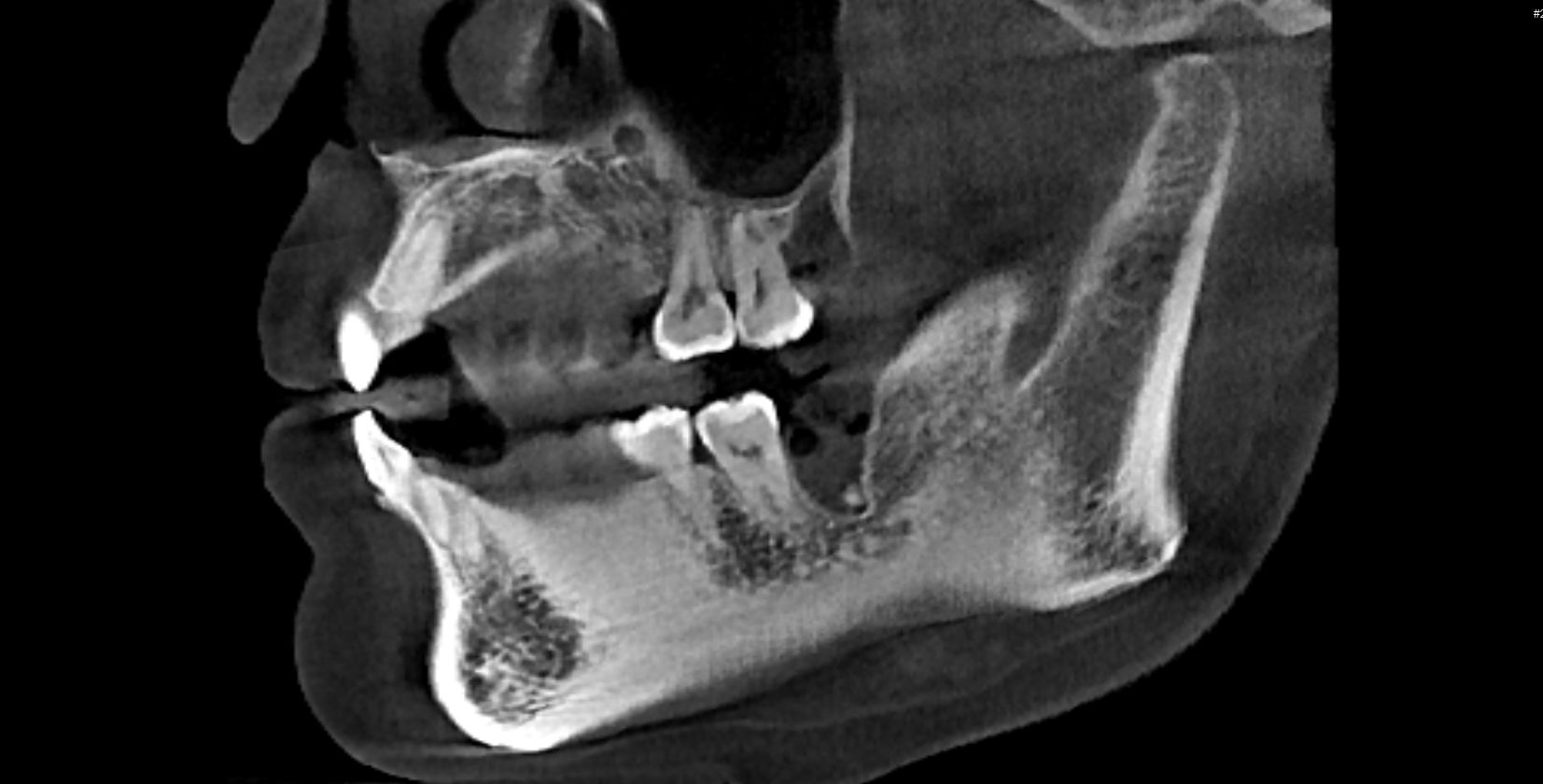 看牙矫正一般去哪里看,矫正牙齿的全套流程